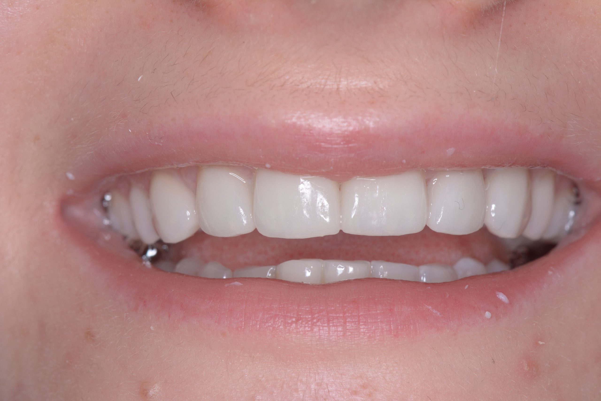 Porcelain Veneers London Dental Specialists