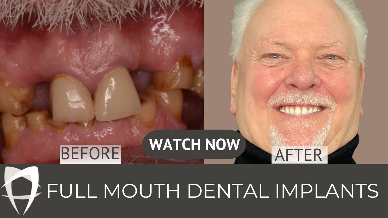 Before and after of Robert’s full mouth dental implant treatment