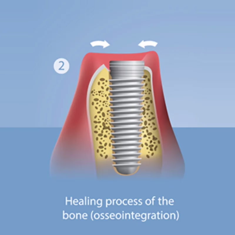 Step 2: the bone heals around the implant (osseointegration)