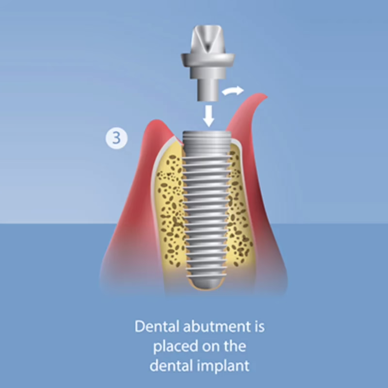 Step 3: the abutment is placed on the dental implant