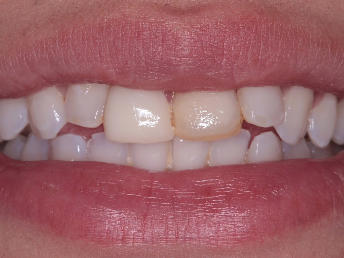 Before dental implant treatment, case 1