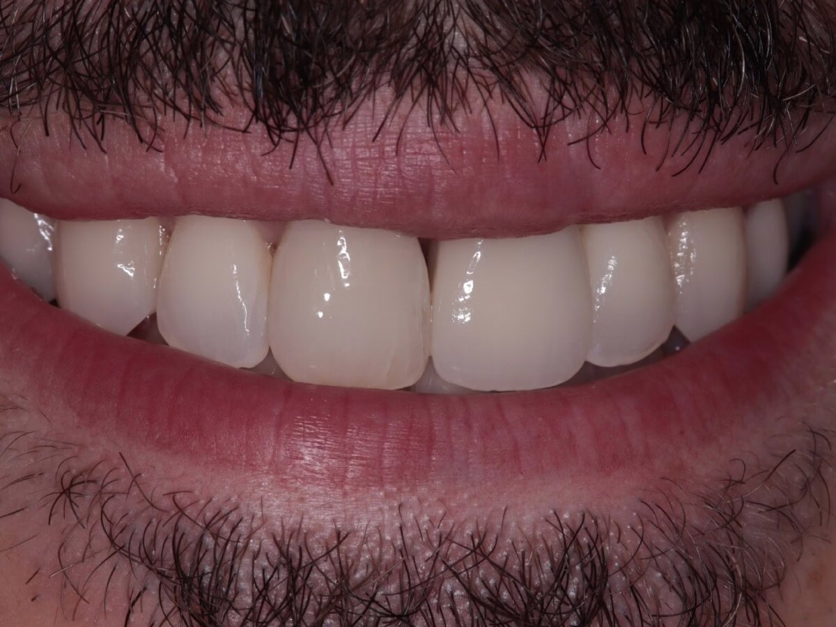After dental implant treatment, case 2: a missing front tooth replaced with a dental implant