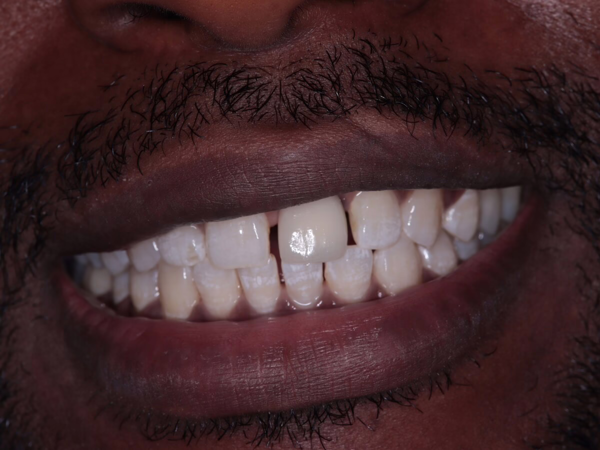 After dental implant treatment, case 3: a damaged front tooth and gap restored to a clean, natural smile